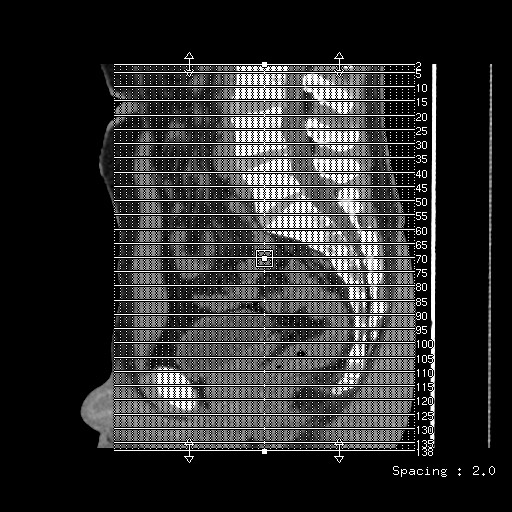 Chondrosarcoma of iliac wing (Radiopaedia 63861-72599 Axial non-contrast 1).jpg