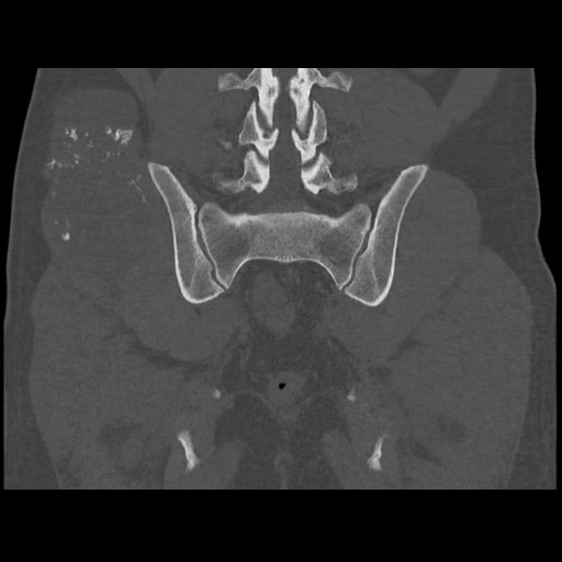 Chondrosarcoma of iliac wing (Radiopaedia 63861-72599 Coronal bone window 80).jpg