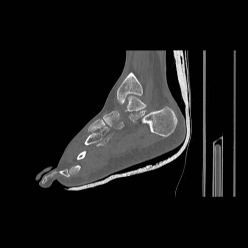 File:Chopart fracture (Radiopaedia 12386-12650 Sagittal bone window 22).jpg