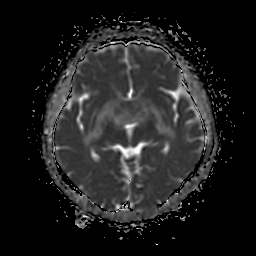 File:Chordoid glioma of third ventricle (Radiopaedia 91612-109340 Axial ADC 14).jpg