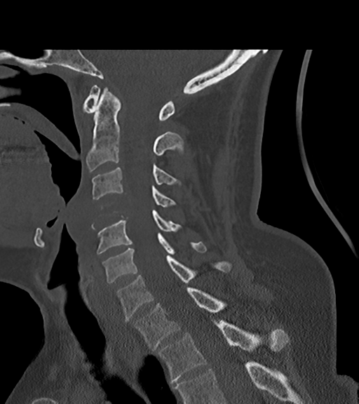 File:Chordoma (C4 vertebra) (Radiopaedia 47561-52188 Sagittal bone window 42).png