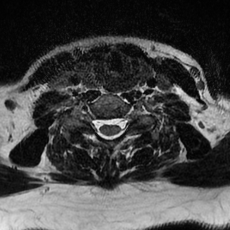 Chordoma - cervical spine (Radiopaedia 70084-80111 Axial T2 66).png
