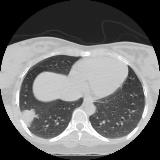 File:Choriocarcinoma of ovary with cerebral and pulmonary metastases (Radiopaedia 25983-26119 Axial lung window 18).jpg