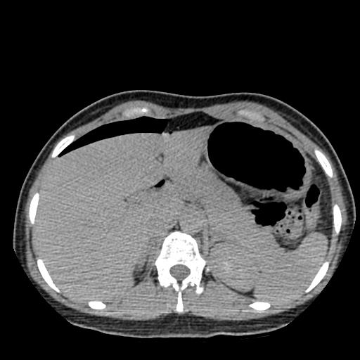 File:Choriocarcinoma of ovary with cerebral and pulmonary metastases (Radiopaedia 25983-26119 Axial non-contrast 78).jpg