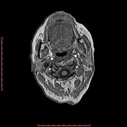 File:Choroid plexus xanthogranuloma (Radiopaedia 67843-77270 Axial T1 166).jpg