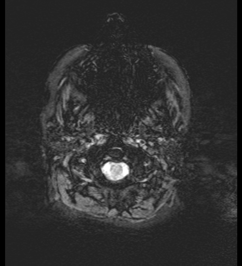 Choroid plexus xanthogranuloma (Radiopaedia 91271-108875 Axial SWI 2).jpg
