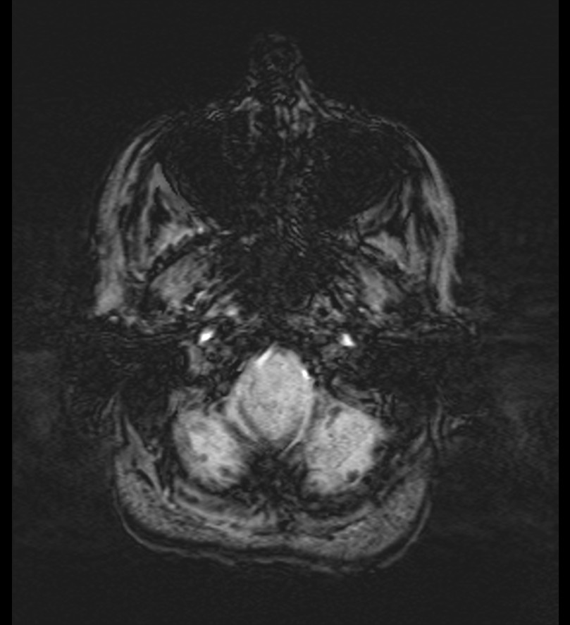 Choroid plexus xanthogranuloma (Radiopaedia 91271-108875 Axial SWI 9).jpg