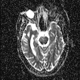 Choroid plexus xanthogranuloma - unilateral (Radiopaedia 85632-101393 Axial ADC 24).jpg
