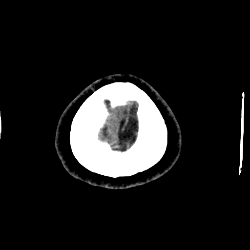 File:Choroid plexus xanthogranulomas (Radiopaedia 51621-57408 Axial non-contrast 113).jpg