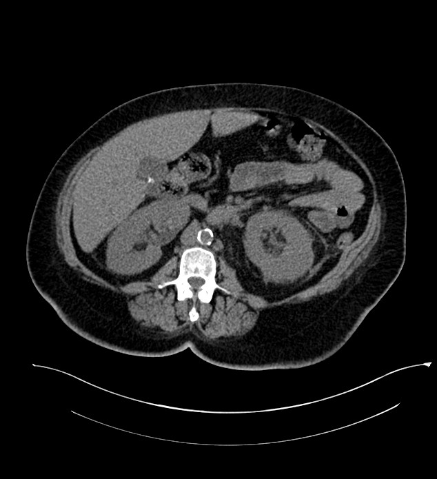 Chromophobe renal cell carcinoma (Radiopaedia 84239-99519 Axial non-contrast 81).jpg
