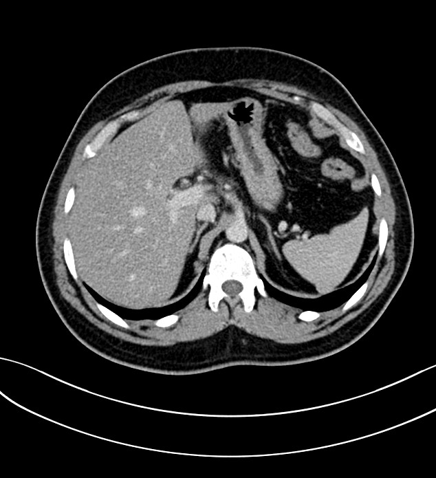 Chromophobe renal cell carcinoma (Radiopaedia 84286-99573 G 15).jpg