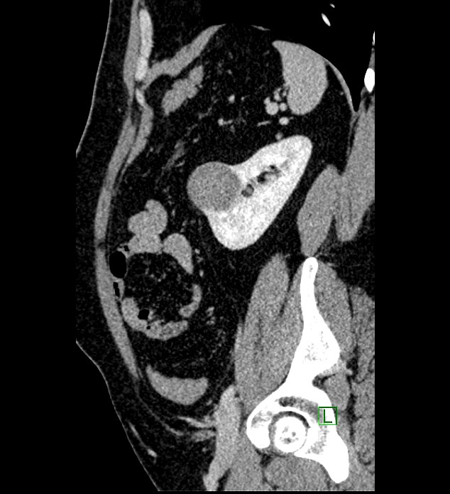 Chromophobe renal cell carcinoma (Radiopaedia 84286-99573 I 48).jpg