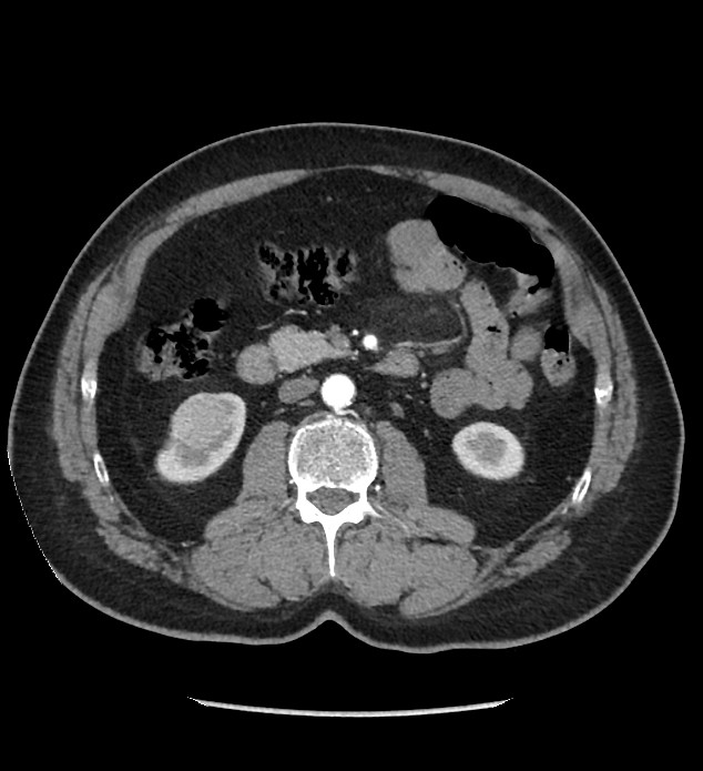 Chromophobe renal cell carcinoma (Radiopaedia 86879-103083 B 67).jpg