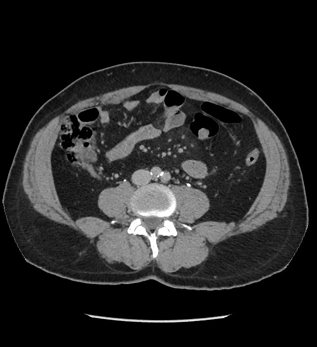 Chromophobe renal cell carcinoma (Radiopaedia 86879-103083 D 86).jpg