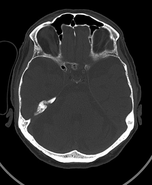 Chronic bilateral subdural hygroma (Radiopaedia 85801-101623 Axial bone window 84).jpg