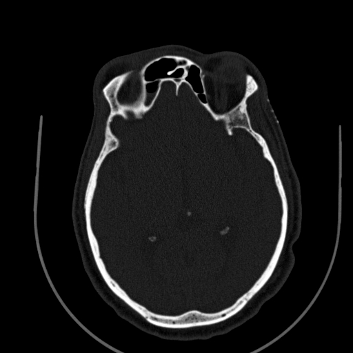 Chronic invasive fungal sinusitis (Radiopaedia 91563-109286 Axial sinus 119).jpg