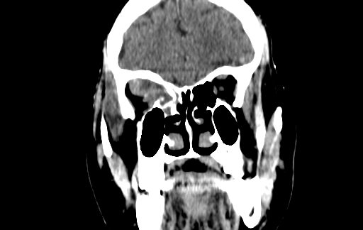 Chronic invasive fungal sinusitis (Radiopaedia 91563-109286 D 44).jpg