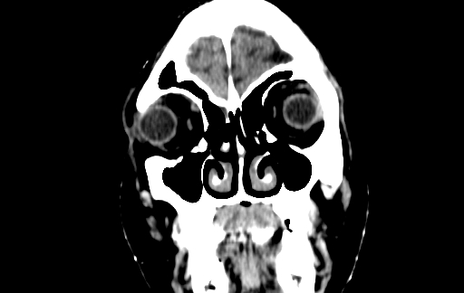 Chronic invasive fungal sinusitis (Radiopaedia 91563-109286 D 6).jpg