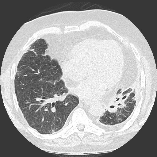 Chronic lung allograft dysfunction - restrictive form (Radiopaedia 60595-68316 Axial lung window 44).jpg