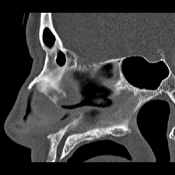 Chronic maxillary sinusitis (Radiopaedia 27879-28116 Sagittal bone window 27).jpg
