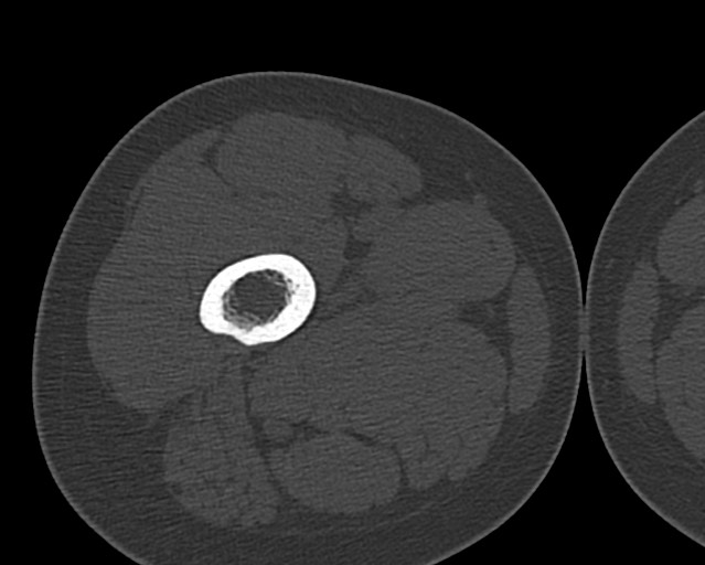 Chronic ostemyelitis of the femur with long sinus tract (Radiopaedia 74947-85982 Axial bone window 53).jpg