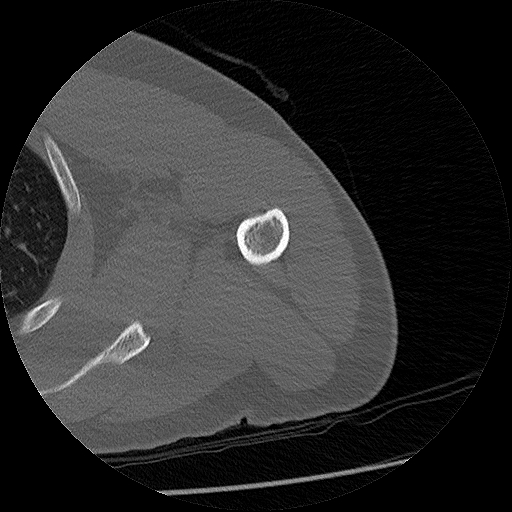 Chronic osteomyelitis (Radiopaedia 67597-76998 Axial bone window 14).jpg