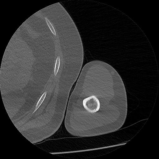 Chronic osteomyelitis (Radiopaedia 67597-76998 Axial bone window 37).jpg
