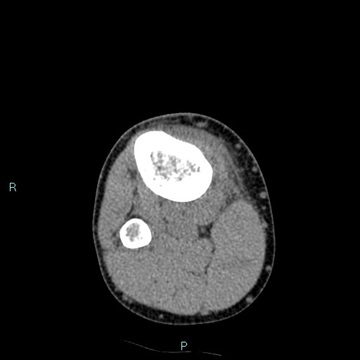 Chronic osteomyelitis (with Brodie abscess) (Radiopaedia 76405-88111 A 64).jpg