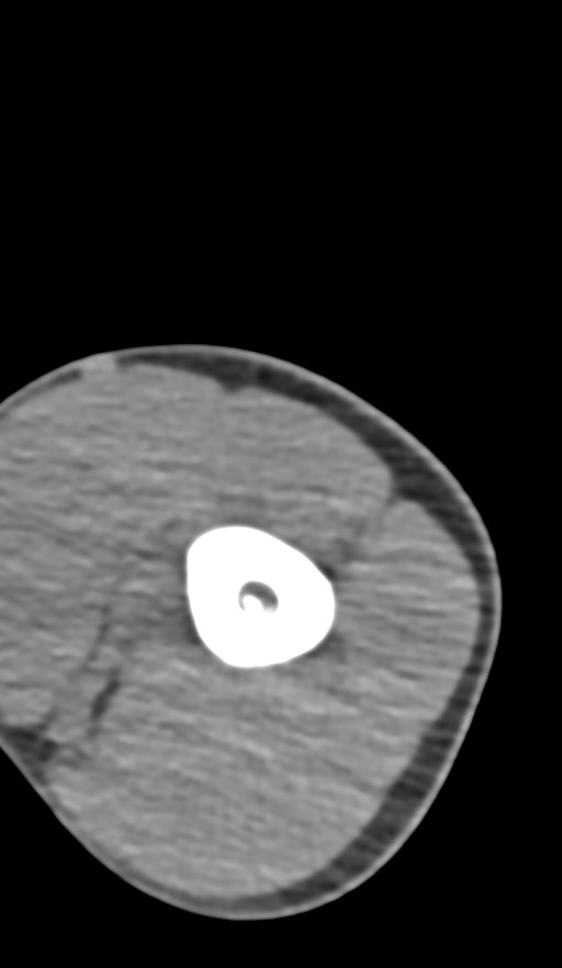 Chronic osteomyelitis of the distal humerus (Radiopaedia 78351-90971 Axial non-contrast 42).jpg