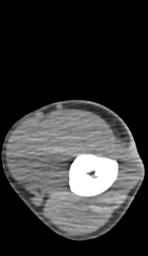 Chronic osteomyelitis of the distal humerus (Radiopaedia 78351-90971 Axial non-contrast 67).jpg