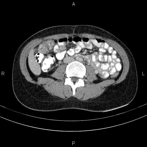 File:Chronic pancreatitis (Radiopaedia 64576-73450 C 94).jpg