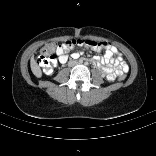 Chronic pancreatitis (Radiopaedia 64576-73450 C 97).jpg