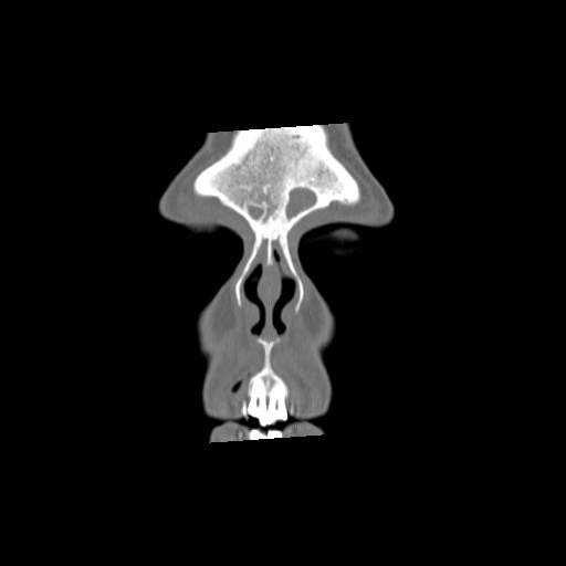File:Chronic sinusitis with intra-sinus calcification (Radiopaedia 63919-72668 Coronal bone window 3).jpg
