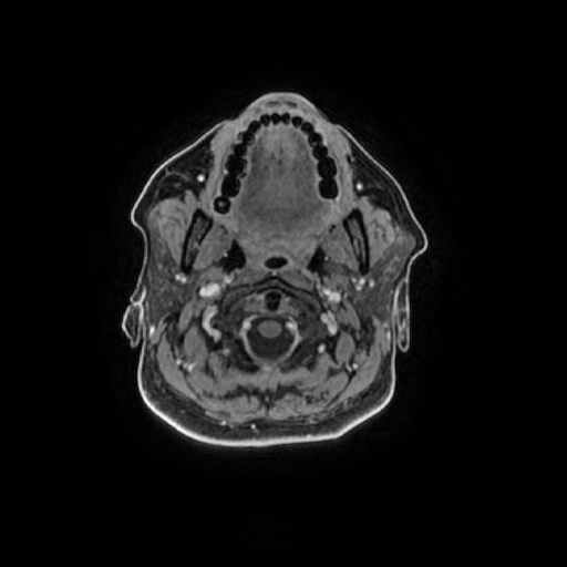 Chronic submandibular sialadenitis (Radiopaedia 61852-69885 Axial T1 C+ fat sat 88).jpg