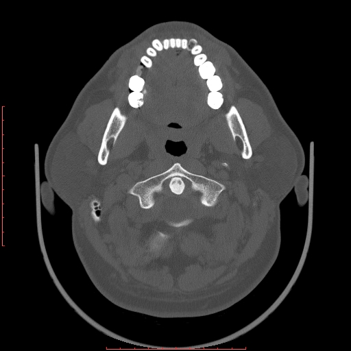 Chronic submandibular sialolithiasis (Radiopaedia 69817-79814 Axial bone window 28).jpg