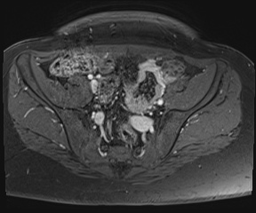 File:Class II Mullerian duct anomaly- unicornuate uterus with rudimentary horn and non-communicating cavity (Radiopaedia 39441-41755 Axial T1 fat sat 26).jpg