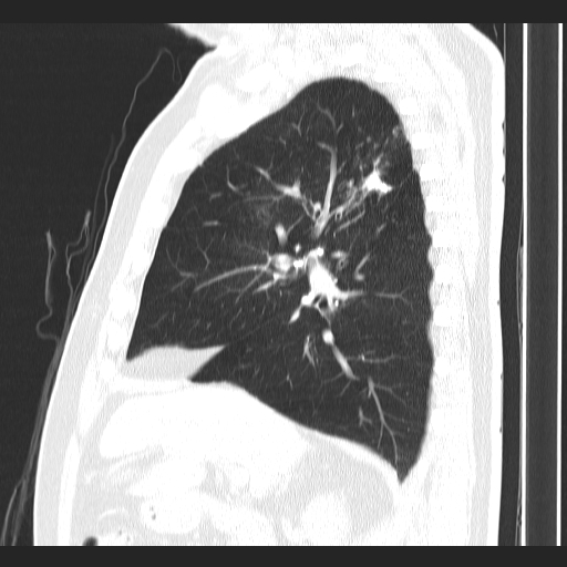File:Classic complicated silicosis (Radiopaedia 49720-54961 Sagittal lung window 41).jpg
