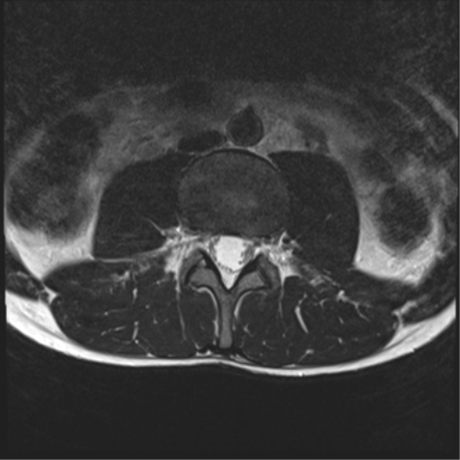 File:Clear cell meningoma - lumbar spine (Radiopaedia 60116-67690 Axial T2 25).png