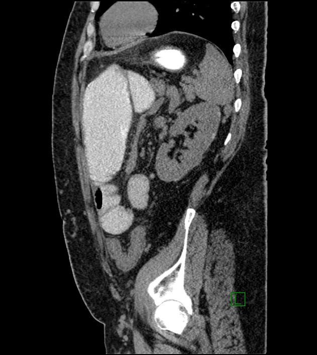 Closed-loop small bowel obstruction-internal hernia (Radiopaedia 78439-91096 C 46).jpg