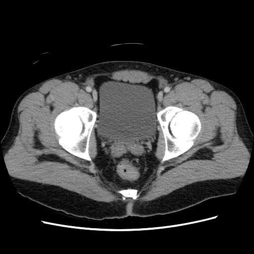 File:Closed-loop small bowel obstruction (Radiopaedia 73713-84509 A 159).jpg