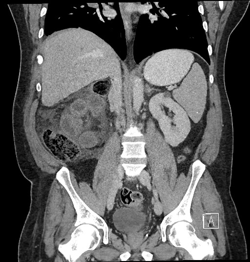 Closed loop obstruction - internal hernia into nephrectomy bed (Radiopaedia 59867-67320 B 82).jpg
