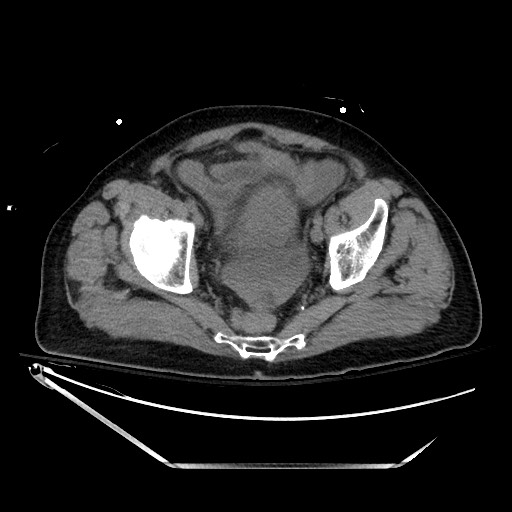File:Closed loop obstruction due to adhesive band, resulting in small bowel ischemia and resection (Radiopaedia 83835-99023 Axial non-contrast 135).jpg
