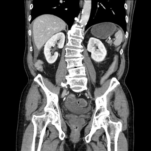 Closed loop obstruction due to adhesive band, resulting in small bowel ischemia and resection (Radiopaedia 83835-99023 E 84).jpg