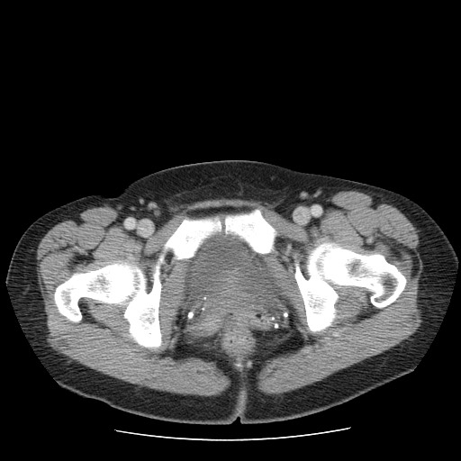 File:Closed loop small bowel obstruction (Radiopaedia 65403-74451 Axial 64).jpg