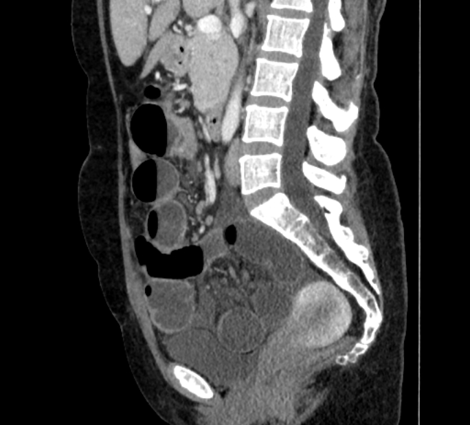 Closed loop small bowel obstruction (Radiopaedia 71211-81508 C 71).jpg