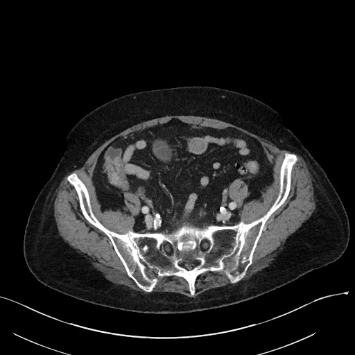 File:Closed loop small bowel obstruction - adhesions (Radiopaedia 59269-66611 A 98).jpg