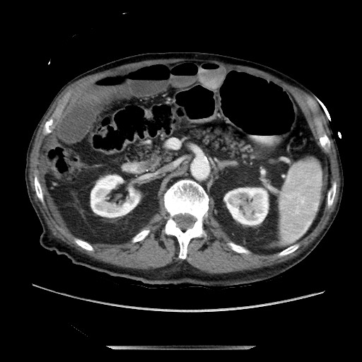 Closed loop small bowel obstruction - adhesive disease and hemorrhagic ischemia (Radiopaedia 86831-102990 A 76).jpg