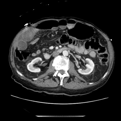 Closed loop small bowel obstruction - adhesive disease and hemorrhagic ischemia (Radiopaedia 86831-102990 A 87).jpg
