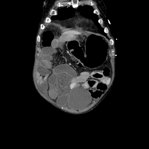 Closed loop small bowel obstruction - adhesive disease and hemorrhagic ischemia (Radiopaedia 86831-102990 B 29).jpg