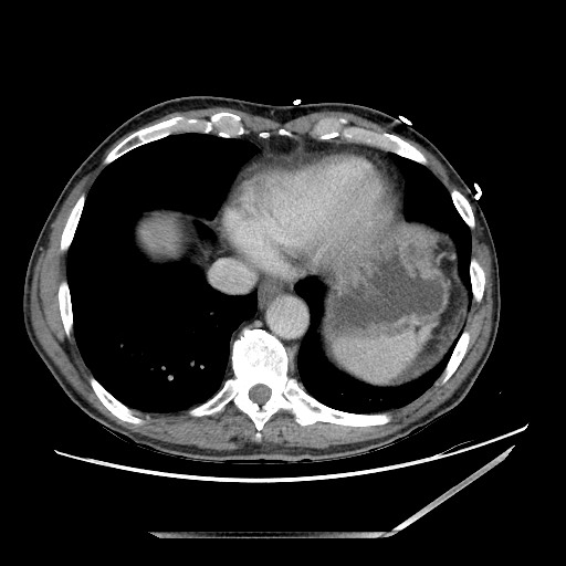 Closed loop small bowel obstruction - omental adhesion causing "internal hernia" (Radiopaedia 85129-100682 A 12).jpg